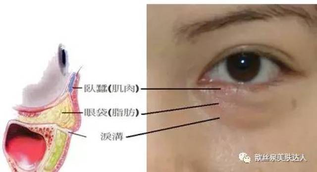 永久性眼袋包括下睑垂挂畸形,睑袋,单纯脂肪膨出眼袋,肌性眼袋四种