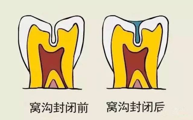 窝沟封闭适应症