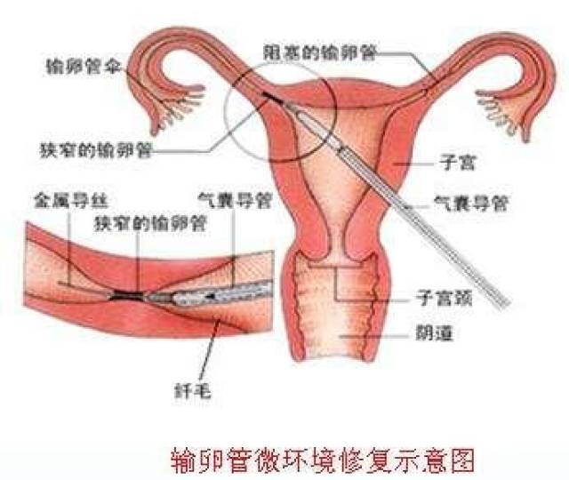 导致女生输卵管不通原因有哪些?