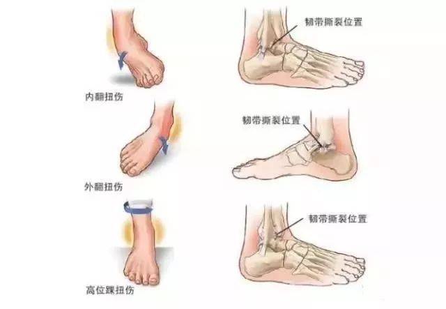 踝关节扭伤是非常常见的运动损伤,多数情况下是指足踝向内过度内翻