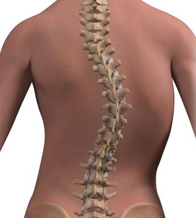 特发性脊柱侧弯示意图(背部)