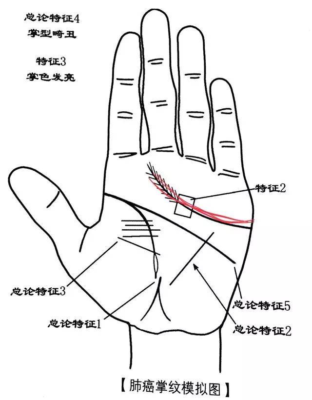 查出肺癌仅三个月,他就走了.
