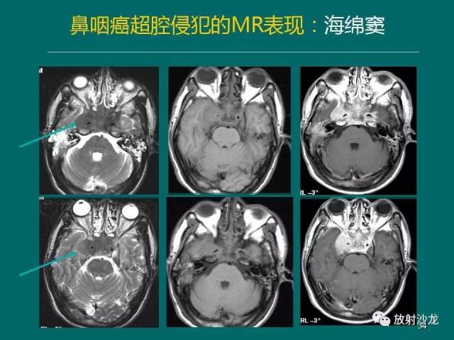 鼻咽癌的mri诊断