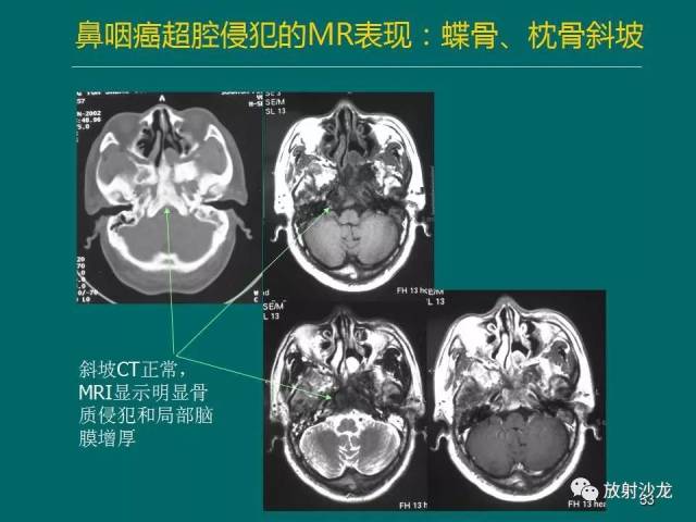 鼻咽癌的mri诊断