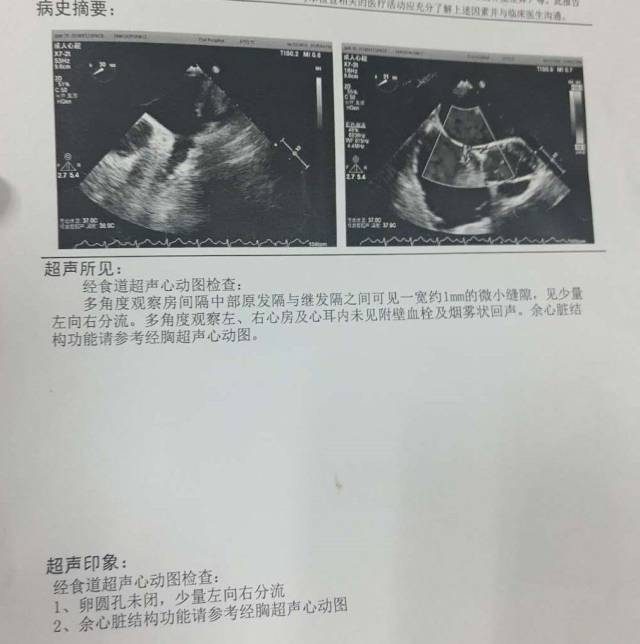 食道超声心动图证实卵圆孔未闭