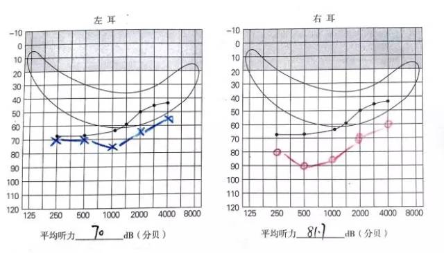 听力学误诊:abr70db一定不需要做人工耳蜗吗?