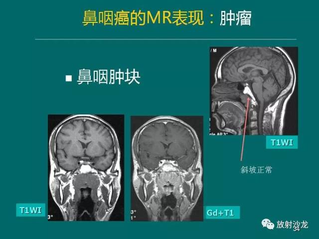 鼻咽癌的mri诊断