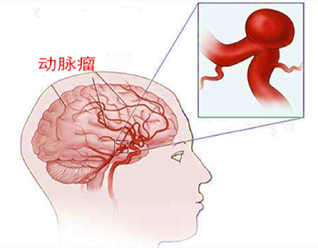 患了颅内动脉瘤,可以吃药控制吗?