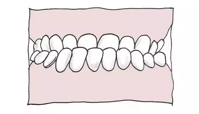 若无法咬合,会导致上下门牙无法切咬食物,说话会漏风喷口水,嘴巴无法