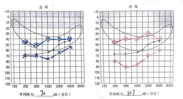 听力学误诊:abr70db一定不需要做人工耳蜗吗?