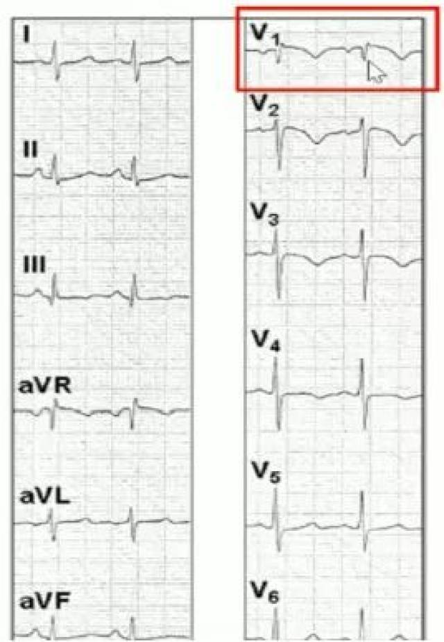 不常见,多为 1 mm的轻度抬高,有siqiiitiii者可合并下壁导联st段抬高