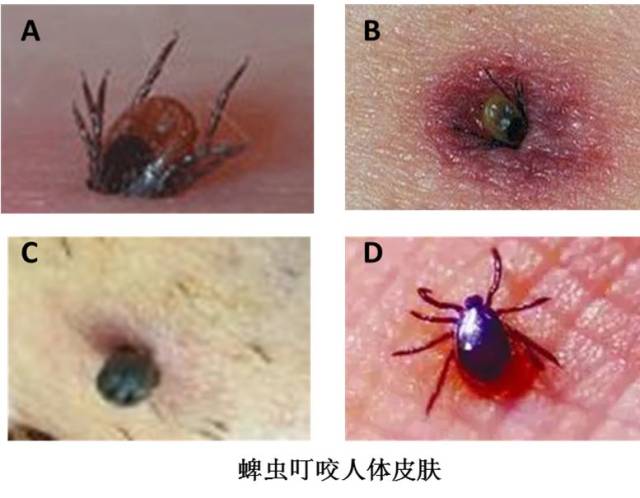 【健康关注】被蜱虫叮咬很可怕?市中研附院皮肤科专家