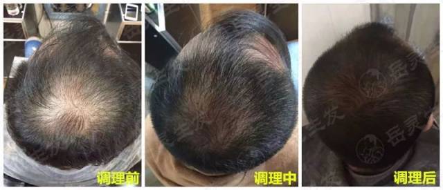 世界杯:留给我的不仅是肥胖,更严重的是脱发