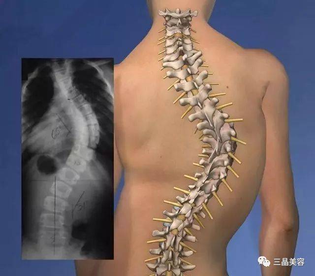 「脊柱侧弯」有多恐怖你知道吗?严重者可影响心肺功能