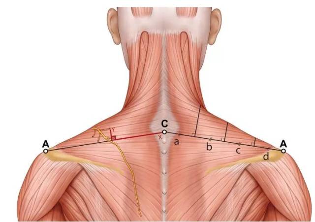 干货| 注射斜方肌上部中副神经的分布——解剖以及临床研究