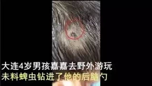 对付蜱虫,有这么几个要点
