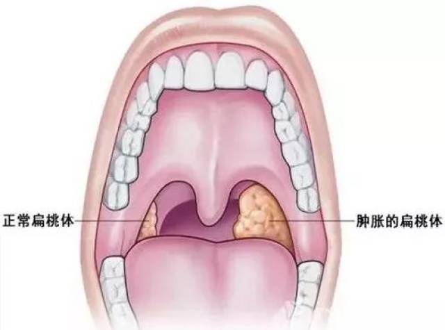 但急性扁桃体炎发作时,不可手术.