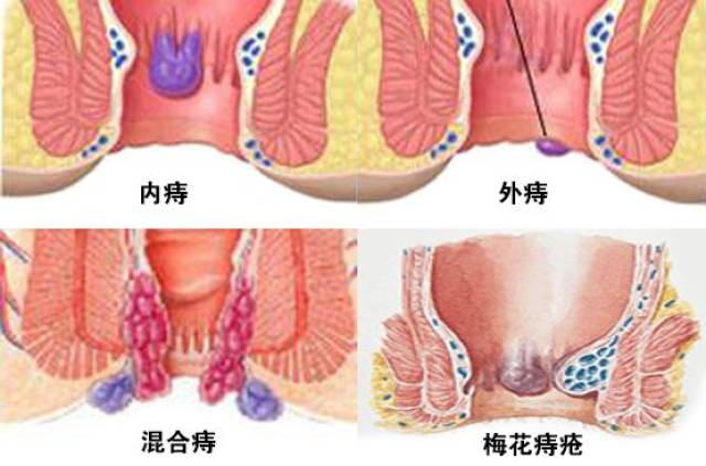 痔疮是怎么得的你知道吗?