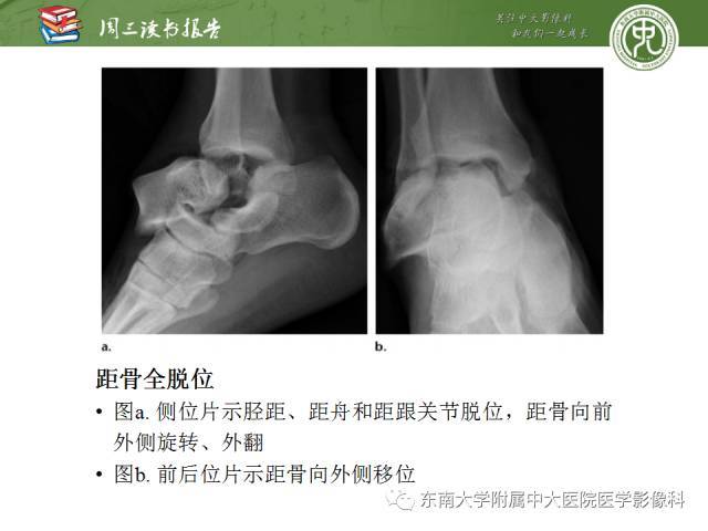 距骨骨折与脱位:放射科医师及时诊断与分类指南