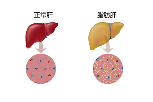 脂肪肝需重视,请别小看他