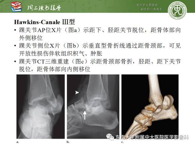 距骨骨折与脱位:放射科医师及时诊断与分类指南