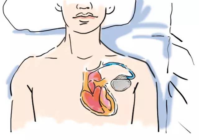 我有一颗机器心——起搏器术后的注意要点