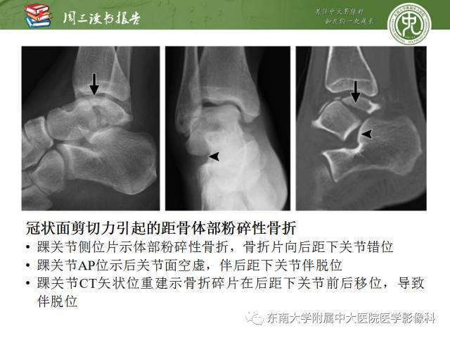 距骨骨折与脱位:放射科医师及时诊断与分类指南