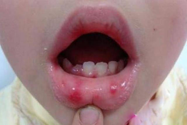 小儿疱疹性咽峡炎是一种发热性疾病,由病毒感染引起的,常见于婴幼儿
