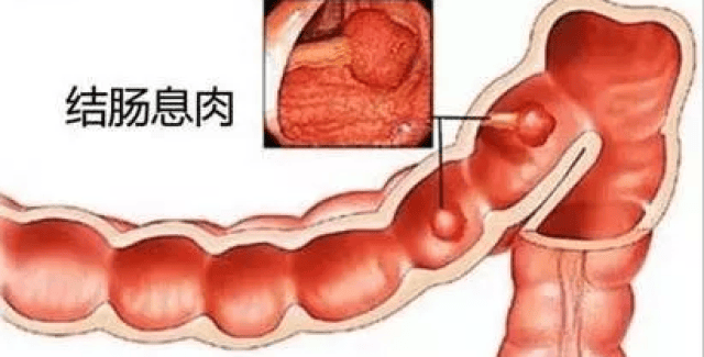 一,先从大肠息肉说起 大肠腺瘤是结直肠息肉中的一种,也叫腺瘤性息肉