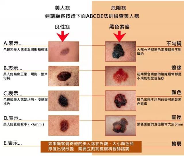 新加坡患皮肤癌的年轻人有上升的趋势!我们该如何预防