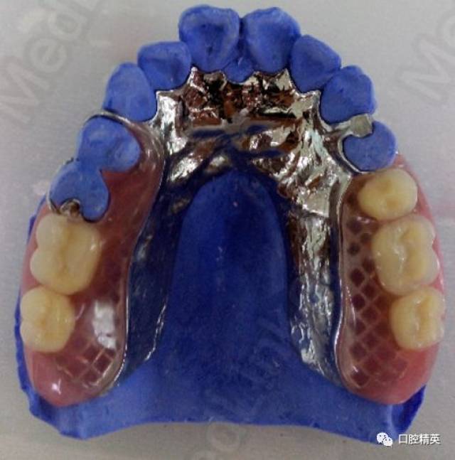 上颌后牙缺失的支架(基板)设计思考