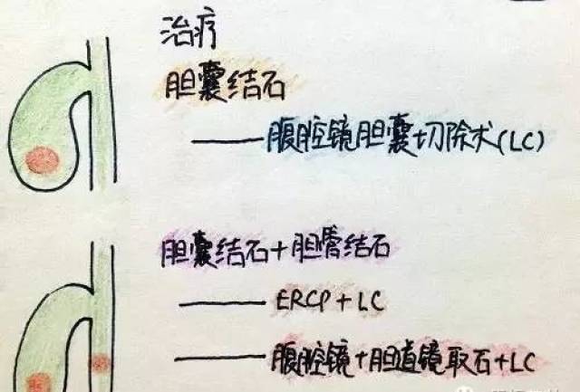 因为胆汁并不是由胆囊分泌,而是由肝脏分泌的,胆囊的主要作用是储存