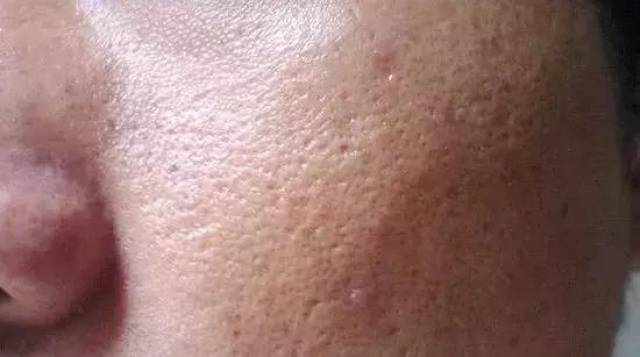 你还在偷偷为脸部毛孔粗大烦恼?一文解决,男女通用