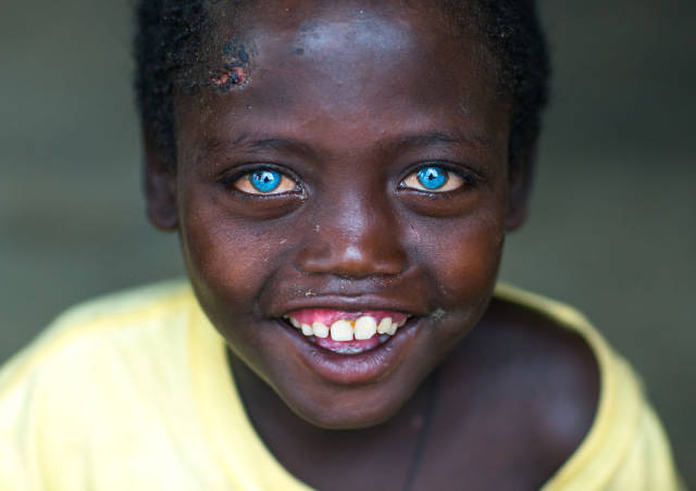 拥有天蓝色美丽眼睛的非洲男孩,被别人视为怪物