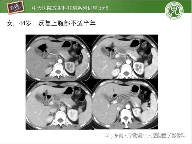 胰腺常见占位病变影像诊断思路