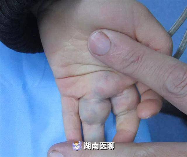 王先生回忆道:小熳刚出生,就被发现 左中指及手掌皮下有青紫肿块.
