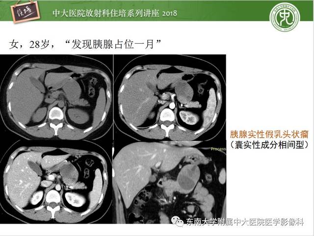 胰腺常见占位病变影像诊断思路