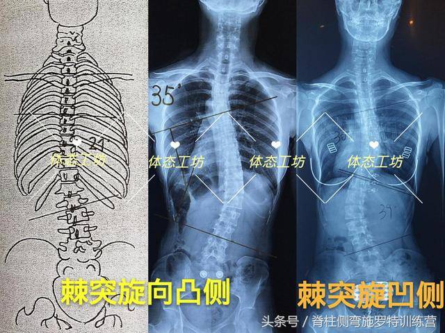 为什么我一定要求看你的x光片?——非典性脊柱侧弯的特别之处
