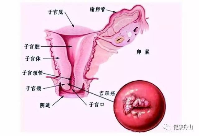 宫颈癌和乳腺癌是女性最适合做早期筛查的癌.