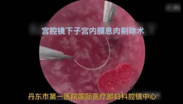 丹东宫颈息肉手术 新生命诞生与之相关