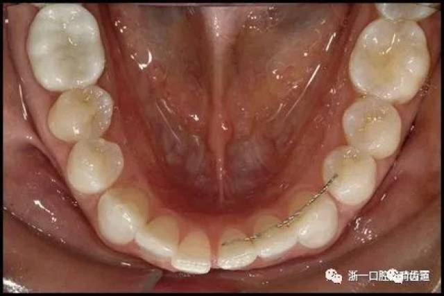 正畸文献阅读--固定舌侧保持器作用下意外的牙