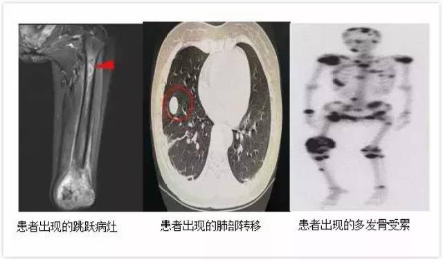 【航天健康大讲堂】孩子老腿疼,小心骨肉瘤