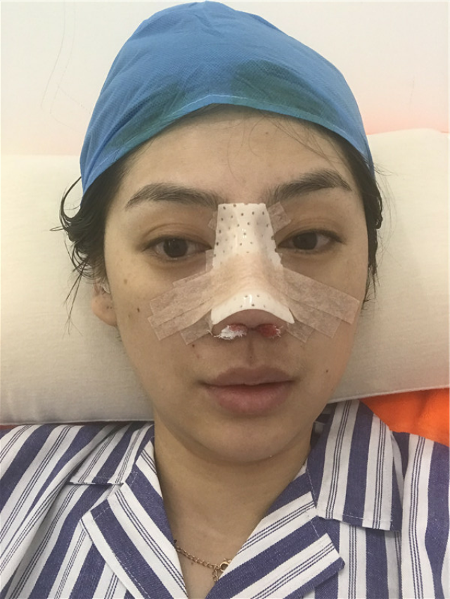 真实案例:隆鼻手术后,朋友们见到我都惊呆啦!