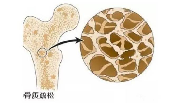 卫生部发布的《防治骨质疏松知识要点》(全文不长,价值非凡)