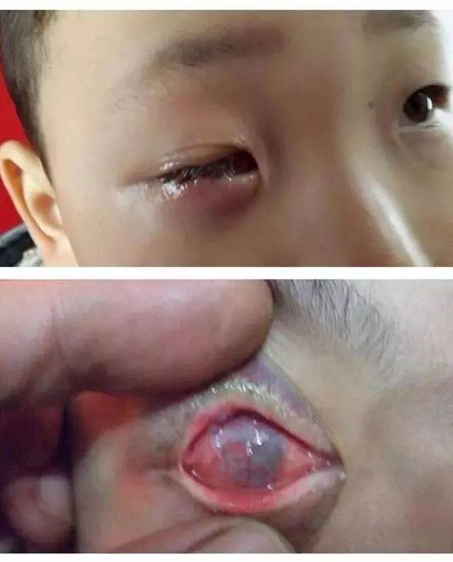 孩子的右眼迅速被碱性液体腐蚀, 尽管送去医院,眼睛还是没有保住,孩子