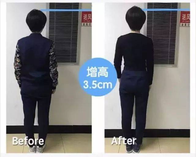 25岁时长高5公分,并帮助无数学员实现增高,他