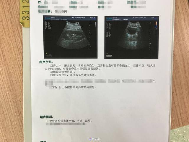 21岁小伙肾脏长出多颗小结石,只因牛奶当水喝?