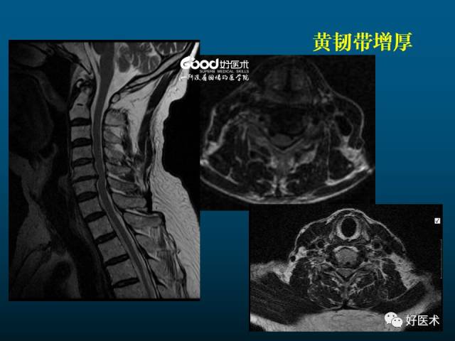 颈椎病的mri诊断技巧!