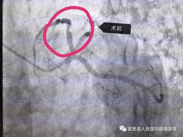 左前降支近段支架植入术后