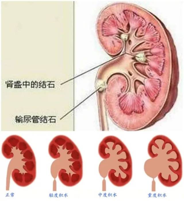 肾结石的长期存在未进行治疗,易引起尿路梗阻,梗阻以上的输尿管和